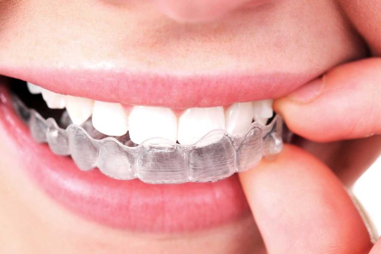 Top 5 Reasons to Get Invisalign?